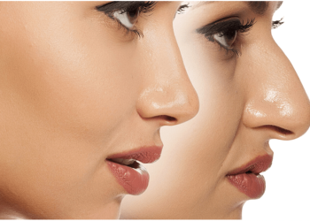 هزینه فیلر بینی در سال 1403