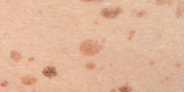 ملانوما چیست؟