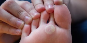 پرسش‌های متداول در مورد میخچه و پینه