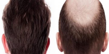 مراحل رشد مو بعد از کاشت مو چگونه است؟