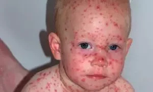 تاول دست در کودکان: علل، پیشگیری و درمان