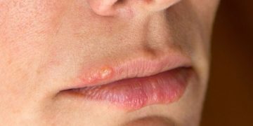 علائم زرد زخم چیست و چه راه‌های درمانی دارد؟