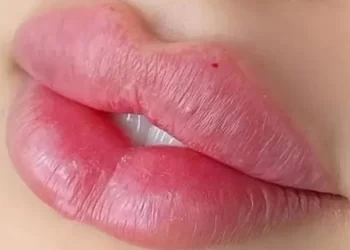 تزریق ژل لب مدل چاک‌دار چیست و چه مزایا و معایبی دارد؟