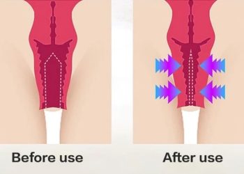 مراقبت های بعد از هایفوتراپی واژن
