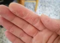 پوسته شدن دست و روش‌های درمانی آسان آن