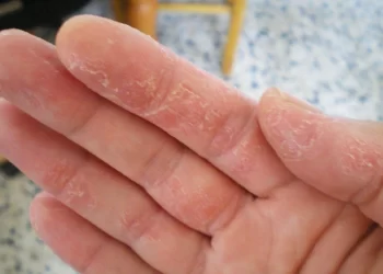 پوسته شدن دست و روش‌های درمانی آسان آن